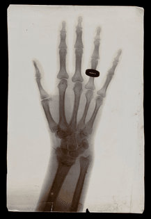 the_bones_of_the_hand_of_mrs_f._bridgeman-_wearing_a_ring_wellcome_l0047928.jpg