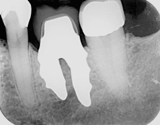 1920px-x-ray_of_root_analogue_dental_implant_two_rooted_left_lower_molar.jpg