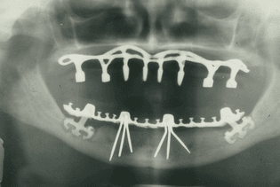 panoramic_radiograph_of_historic_dental_implants.jpg