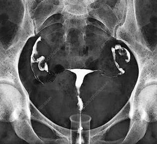 c0488817-healthy_female_reproductive_system-_x-ray.jpeg