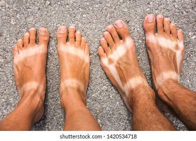 sunburn-on-feet-man-woman-260nw-1420534718.jpg