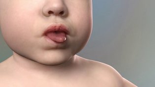 EVIAN DISEASE