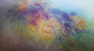 bruise-1.jpeg