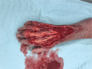 skinned hand