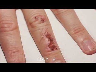 Wound Healing Time Lapse