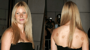 Gwyneth Paltrow cupping marks on the red carpet (2004)