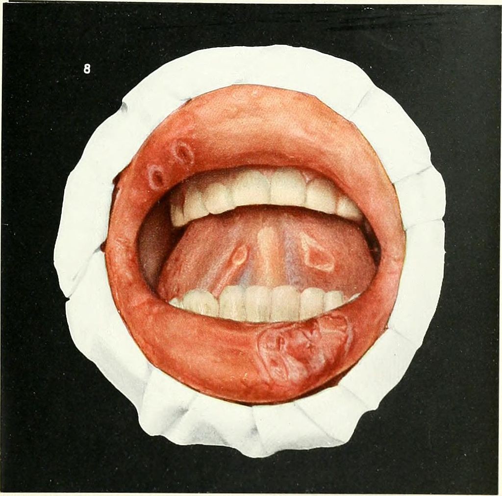 1024px-diseases_of_the_mouth;_for_physicians-_dentists-_medical_and_dental_students_-1912-_-14586253750-.jpg